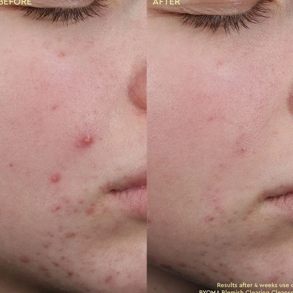 Blemish Clearing Cleanser - Anti-imperfektionsrensning