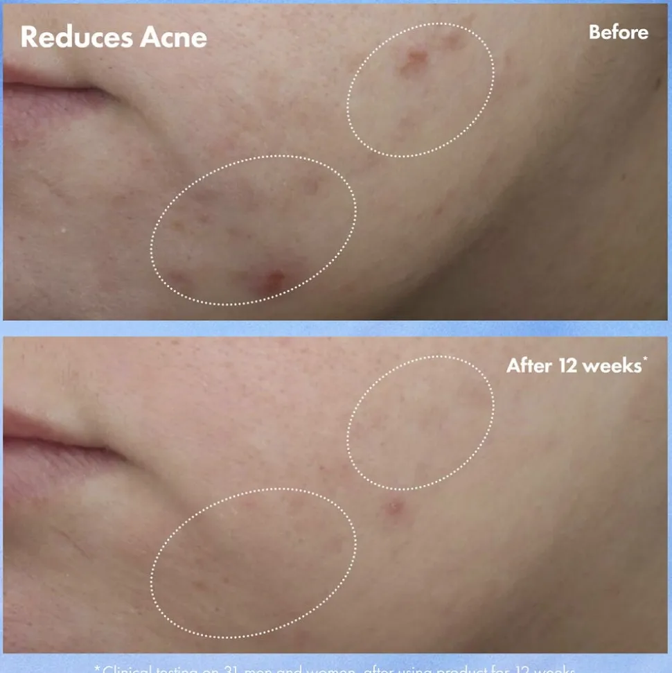 Clear Improvement Acne & Blackhead Clearing Hydrating Moisturizer Loti