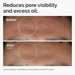 Niacinamide 10% + Zinc 1%